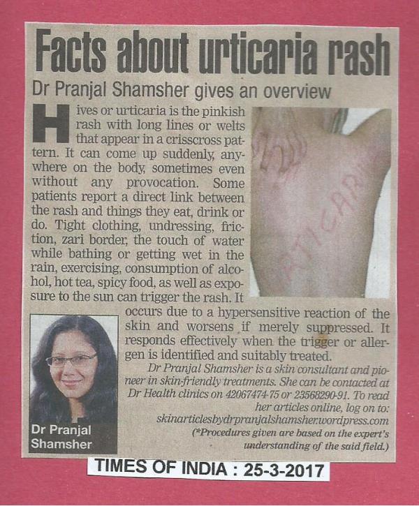 Facts about urticaria rash eng-25-3-2017